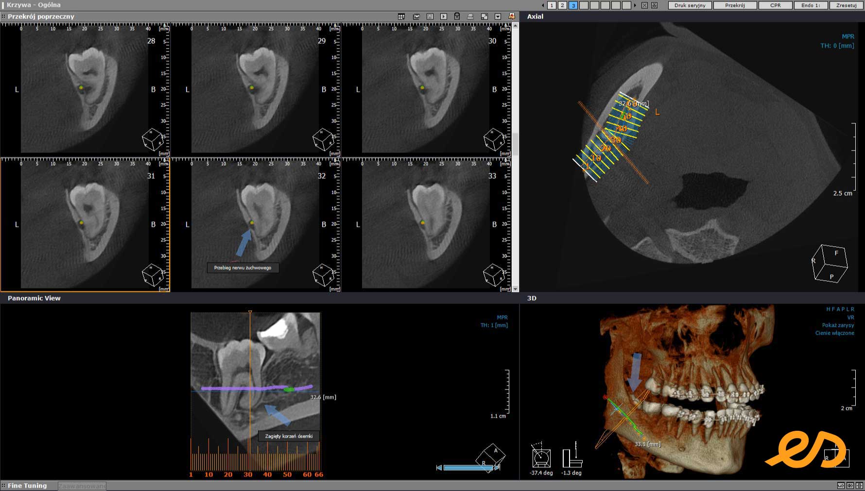 Zrzut ekranu programu do przeglądania zdjęć tomograficznych pokazujący kanał żuchwowy przebiegający blisko zatrzymanego zęba