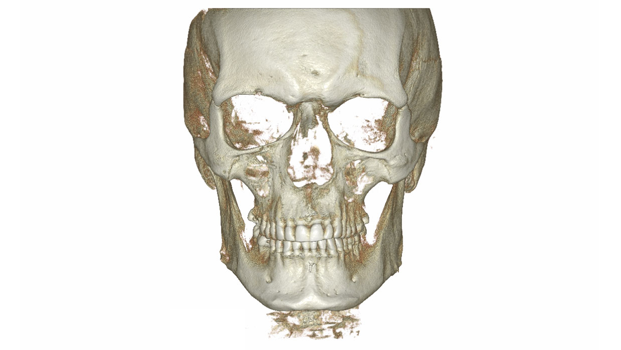Tomografia-twarzoczaszki-3D