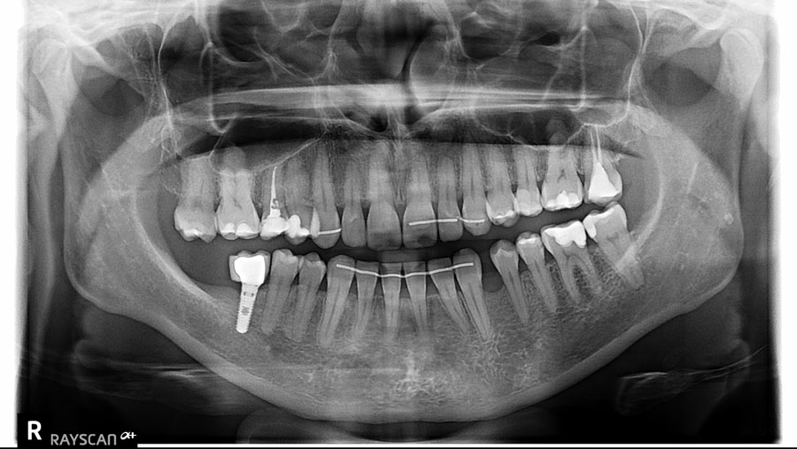 Zdjęcie-ortogonalne-zębów-2D-tomografia